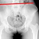 PLANTILLA ALZA PARA DISMETRIAS HASTA 1CM